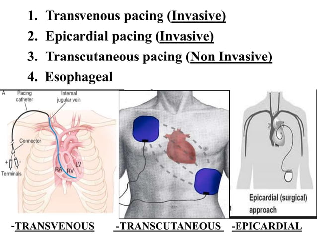 Anaesthesia for patient with pacemaker | PPT