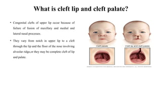 Anaesthesia in cleft and cleft palate surgeries ppt (1) (1).pptx