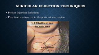 Postauricular Injection Anaesthesia in ent practice | PPTX