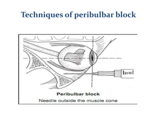 Anaesthesia in ophthalmic surgery | PPT