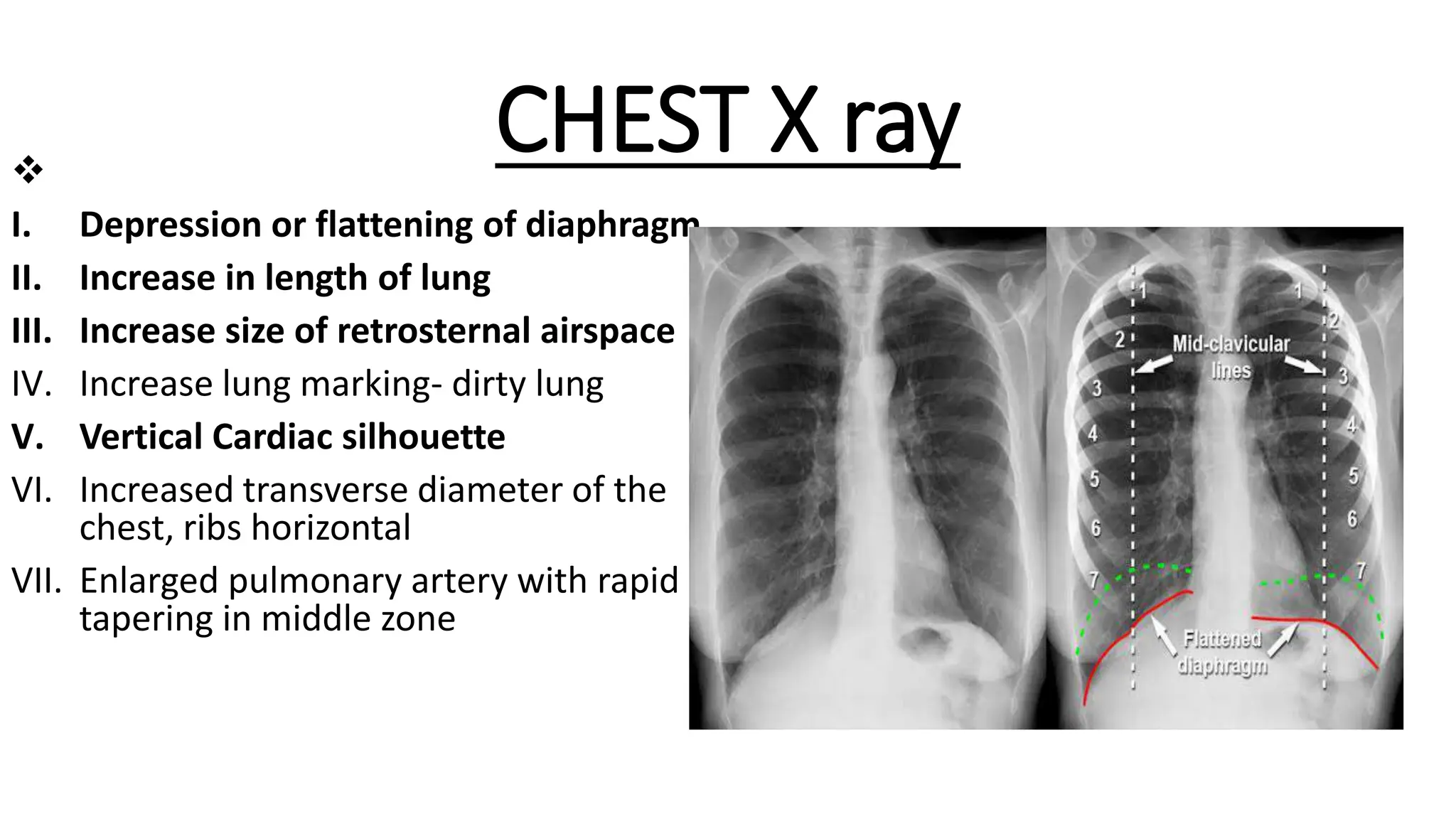 Anaesthesic Considerations in COPD.pptx
