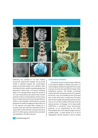 SURETECH was inserted 5-7 cm from midline
0 0
around 30 caudal & 45 medially. The tip of the
needle is directed towards the antero-lateral
aspect of the lower border of L5 vertebra. After
touching the bone needle is gradually grazed and
advanced in lateral view 1 cm past L5 vertebral
body in the retroperitoneal space.The spread of
non ionic radiocontrast dye should show smooth
posterior contour corresponding to anterior psoas
fascia in lateral view and vertical spread lateral to
midline in AP view.After confirming the accurate
placement of needle tip diagnostic block with 5 ml
of 1% xylocard was given.After waiting for 5
minutes some pain relef was confirmed and if no
motor block is observed then neurolysis was done
with 8 ml 10% aqueous phenol.Same procedure
wasrepeatedon theothersidealso.
TRANS-DISCAL TECHNIQUE
The patient was put in prone position With the
C-arm properly aligned in oblique view, there is a
small triangular window through which the needle
must pass to reach the anterolateral margin of the
lumbosacral junction. The triangle is bounded
superiorly by the transverse process of L5, laterally
by the iliac crest, and medially by the L5/SI facet
joint. A skin entry point is made over the lowest
point of this triangle and typically overlies the iliac
crest, 5 to 7 cm from midline at the level of the L5
spinous process. A 22-gauge, 15 cm long needle
SURETECH is advanced using fluoroscopic
guidance to lie anterolateral to the L5/S1
intervertebral disc or the inferior margin of the L5
vertebral body . A small volume (2 to 3 ml) of
radiographic contrast material is seen to spread
Anaesthesiology M.P.24
 