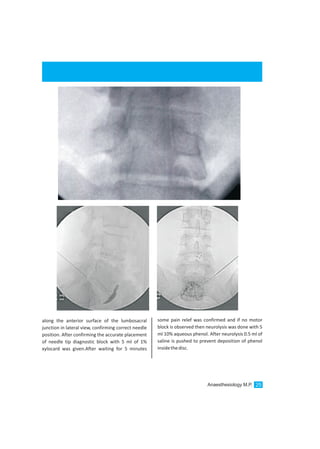 along the anterior surface of the lumbosacral
junction in lateral view, confirming correct needle
position. After confirming the accurate placement
of needle tip diagnostic block with 5 ml of 1%
xylocard was given.After waiting for 5 minutes
some pain relef was confirmed and if no motor
block is observed then neurolysis was done with 5
ml 10% aqueous phenol. After neurolysis 0.5 ml of
saline is pushed to prevent deposition of phenol
insidethedisc.
Anaesthesiology M.P. 25
 