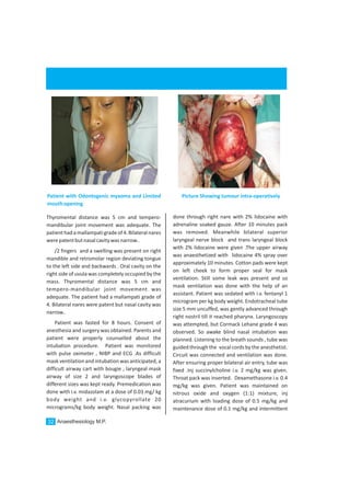 Thyromental distance was 5 cm and tempero-
mandibular joint movement was adequate. The
patienthadamallampatigradeof4.Bilateralnares
werepatentbutnasalcavitywasnarrow..
/2 fingers and a swelling was present on right
mandible and retromolar region deviating tongue
to the left side and backwards . Oral cavity on the
right side of uvula was completely occupied by the
mass. Thyromental distance was 5 cm and
tempero-mandibular joint movement was
adequate. The patient had a mallampati grade of
4. Bilateral nares were patent but nasal cavity was
narrow..
Patient was fasted for 8 hours. Consent of
anesthesia and surgery was obtained. Parents and
patient were properly counselled about the
intubation procedure. Patient was monitored
with pulse oximeter , NIBP and ECG .As difficult
mask ventilation and intubation was anticipated, a
difficult airway cart with bougie , laryngeal mask
airway of size 2 and laryngoscope blades of
different sizes was kept ready. Premedication was
done with i.v. midazolam at a dose of 0.03 mg/ kg
body weight and i.v. glycopyrollate 20
micrograms/kg body weight. Nasal packing was
done through right nare with 2% lidocaine with
adrenaline soaked gauze. After 10 minutes pack
was removed. Meanwhile bilateral superior
laryngeal nerve block and trans laryngeal block
with 2% lidocaine were given .The upper airway
was anaesthetized with lidocaine 4% spray over
approximately 10 minutes. Cotton pads were kept
on left cheek to form proper seal for mask
ventilation. Still some leak was present and so
mask ventilation was done with the help of an
assistant. Patient was sedated with i.v. fentanyl 1
microgram per kg body weight. Endotracheal tube
size 5 mm uncuffed, was gently advanced through
right nostril till it reached pharynx. Laryngoscopy
was attempted, but Cormack Lehane grade 4 was
observed. So awake blind nasal intubation was
planned. Listening to the breath sounds , tube was
guided through the vocal cords by the anesthetist.
Circuit was connected and ventilation was done.
After ensuring proper bilateral air entry, tube was
fixed .Inj succinylcholine i.v. 2 mg/kg was given.
Throat pack was inserted. Dexamethasone i.v. 0.4
mg/kg was given. Patient was maintained on
nitrous oxide and oxygen (1:1) mixture, inj
atracurium with loading dose of 0.5 mg/kg and
maintenance dose of 0.1 mg/kg and intermittent
Patient with Odontogenic myxoma and Limited
mouthopening
Picture Showing tumour intra-operatively
Anaesthesiology M.P.32
 