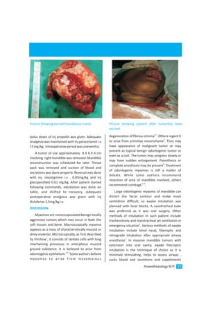 bolus doses of inj propofol was given. Adequate
analgesia was maintained with inj paracetamol i.v
15mg/kg.Intraoperativeperiodwasuneventful.
A tumor of size approximately 8 X 6 X 6 cm
involving right mandible was removed .Mandible
reconstruction was scheduled for later. Throat
pack was removed and suction of blood and
secretions was done properly. Reversal was done
with inj. neostigmine i.v . 0.05mg/kg and inj
glycopyrollate 0.01 mg/kg. After patient started
following commands, extubation was done on
table, and shifted to recovery .Adequate
postoperative analgesia was given with inj
diclofenac1.5mg/kgi.v.
Myxomas are nonencapsulated benign locally
aggressive tumors which may occur in both the
soft tissues and bone. Macroscopically myxoma
appears as a mass of characteristically mucoid or
slimy material. Microscopically, as first described
2
by Virchow , it consists of stellate cells with long
intertwining processes in amorphous mucoid
ground substance. It is believed to arise from
3,4,5
odontogenic epithelium. Some authors believe
myxomas to arise from myxomatous
DISCUSSION
6,7
degeneration of fibrous stroma . Others regard it
8
to arise from primitive mesenchyme . They may
have appearance of malignant tumor or may
present as typical benign odontogenic tumor or
even as a cyst. The tumor may progress slowly or
may have sudden enlargement. Paresthesia or
9
complete anesthesia may be present . Treatment
of odontogenic myxomas is still a matter of
debate. While some authors recommend
resection of area of mandible involved, others
9,10
recommendcurettage .
Large odontogenic myxoma of mandible can
distort the facial contour and make mask
ventilation difficult, so awake intubation was
planned with local blocks. A nasotracheal tube
was preferred as it was oral surgery. Other
methods of intubation in such patient include
tracheostomy and transtracheal jet ventilation in
1
emergency situation . Various methods of awake
intubation include blind nasal, fiberoptic and
retrograde intubation after appropriate airway
1
anesthesia . In massive mandible tumors with
extension into oral cavity, awake fiberoptic
intubation is the technique of choice as it is
minimaly stimulating, helps to assess airway ,
sucks blood and secretions and supplements
PictureShowingexcisedmandibulartumor Picture showing patient after tumorhas been
excised
Anaesthesiology M.P. 33
 