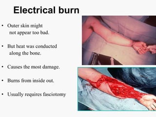 Electrical burn
• Outer skin might
not appear too bad.
• But heat was conducted
along the bone.
• Causes the most damage.
• Burns from inside out.
• Usually requires fasciotomy
18
 