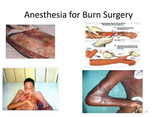 Anesthesia for Burn Surgery
29
 