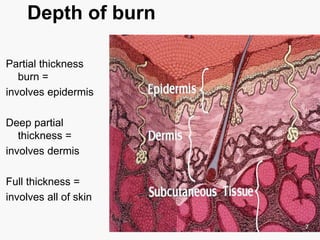 Depth of burn
Partial thickness
burn =
involves epidermis
Deep partial
thickness =
involves dermis
Full thickness =
involves all of skin
7
 