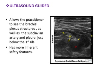 ULTRASOUND GUIDED
• Allows the practitioner
to see the brachial
plexus structures , as
well as the subclavian
artery and pleura, just
below the 1st rib.
• Has more inherent
safety features.
 