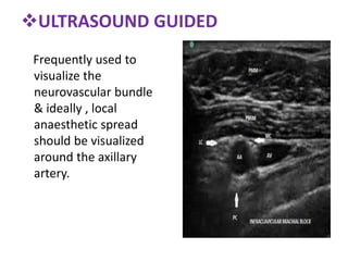 ULTRASOUND GUIDED
Frequently used to
visualize the
neurovascular bundle
& ideally , local
anaesthetic spread
should be visualized
around the axillary
artery.
 