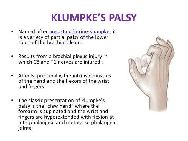 Image result for Dejerine-Klumpke palsy, inferior distal type