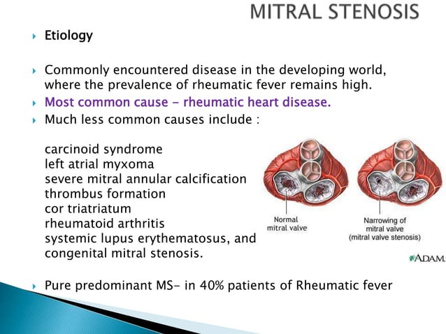 Anaesthetic management of mitral valvular heart disease | PPTX