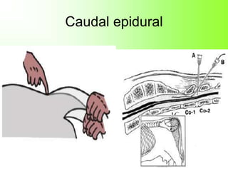 Caudal epidural
 
