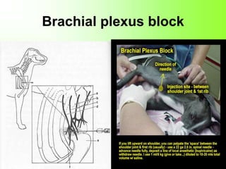 Brachial plexus block
 