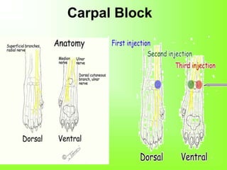 Carpal Block
 