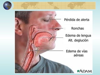 Pérdida de alerta Ronchas Edema de lengua  Alt. deglución Edema de vías aéreas 