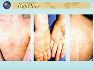 Ronchas  