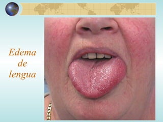 Edema de lengua 