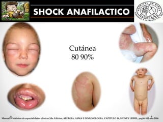 SHOCK ANAFILACTICO
Cutánea
80 90%
Manual Washinton de especialidades clinicas 2da. Edicion, ALERGIA, ASMA E INMUNOLOGIA, CAPITULO 14, SIDNEY LEIBEL, pag96-102-año 2006
 