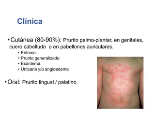 Clínica
•Cutánea (80-90%): Prurito palmo-plantar, en genitales,
cuero cabelludo o en pabellones auriculares.
• Eritema
• Prurito generalizado
• Exantema.
• Urticaria y/o angioedema
•Oral: Prurito lingual / palatino.
 
