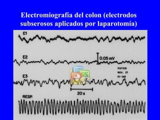 Electromiografía del colon (electrodos subserosos aplicados por laparotomía) 