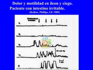 Dolor y motilidad en íleon y ciego.  Paciente con intestino irritable.  (Kellow, Phillips, GE 1989) 