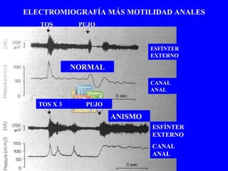 ELECTROMIOGRAFÍA MÁS MOTILIDAD ANALES TOS  PUJO ESFÍNTER EXTERNO CANAL ANAL ESFÍNTER EXTERNO CANAL ANAL TOS X 3  PUJO NORMAL ANISMO 