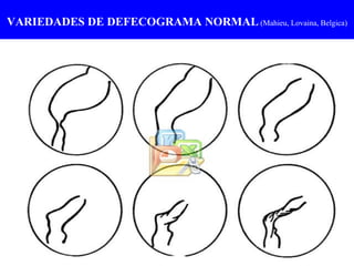 VARIEDADES DE DEFECOGRAMA NORMAL  (Mahieu, Lovaina, Belgica) 