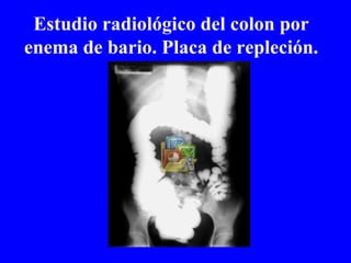 Estudio radiológico del colon por enema de bario. Placa de repleción. 