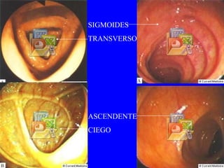 SIGMOIDES TRANSVERSO ASCENDENTE CIEGO 