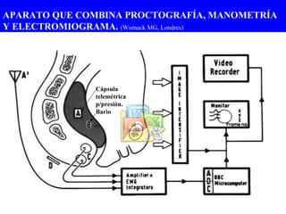 APARATO QUE COMBINA PROCTOGRAFÍA, MANOMETRÍA Y ELECTROMIOGRAMA.  (Womack MG, Londres) Cápsula telemétrica p/presión.  Bario 