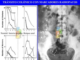 TRÁNSITO COLÓNICO CON MARCADORES RADIOPACOS Normal. Inercia derecha. Retraso anal 