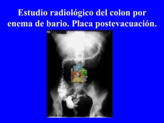 Estudio radiológico del colon por enema de bario. Placa postevacuación. 