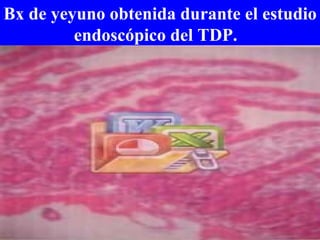 Bx de yeyuno obtenida durante el estudio endoscópico del TDP.  