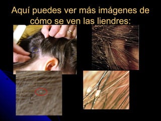 Aquí puedes ver más imágenes deAquí puedes ver más imágenes de
cómo se ven las liendres:cómo se ven las liendres:
 
