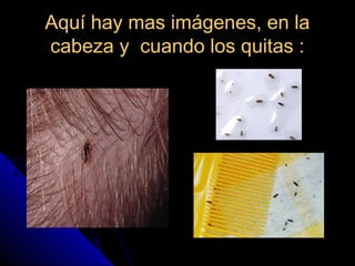 Aquí hay mas imágenes, en laAquí hay mas imágenes, en la
cabeza y cuando los quitas :cabeza y cuando los quitas :
 