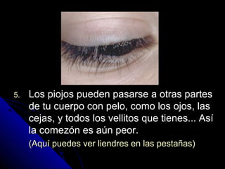 5.5. Los piojos pueden pasarse a otras partesLos piojos pueden pasarse a otras partes
de tu cuerpo con pelo, como los ojos, lasde tu cuerpo con pelo, como los ojos, las
cejas, y todos los vellitos que tienes... Asícejas, y todos los vellitos que tienes... Así
la comezón es aún peor.la comezón es aún peor.
(Aquí puedes ver liendres en las pestañas)(Aquí puedes ver liendres en las pestañas)
 