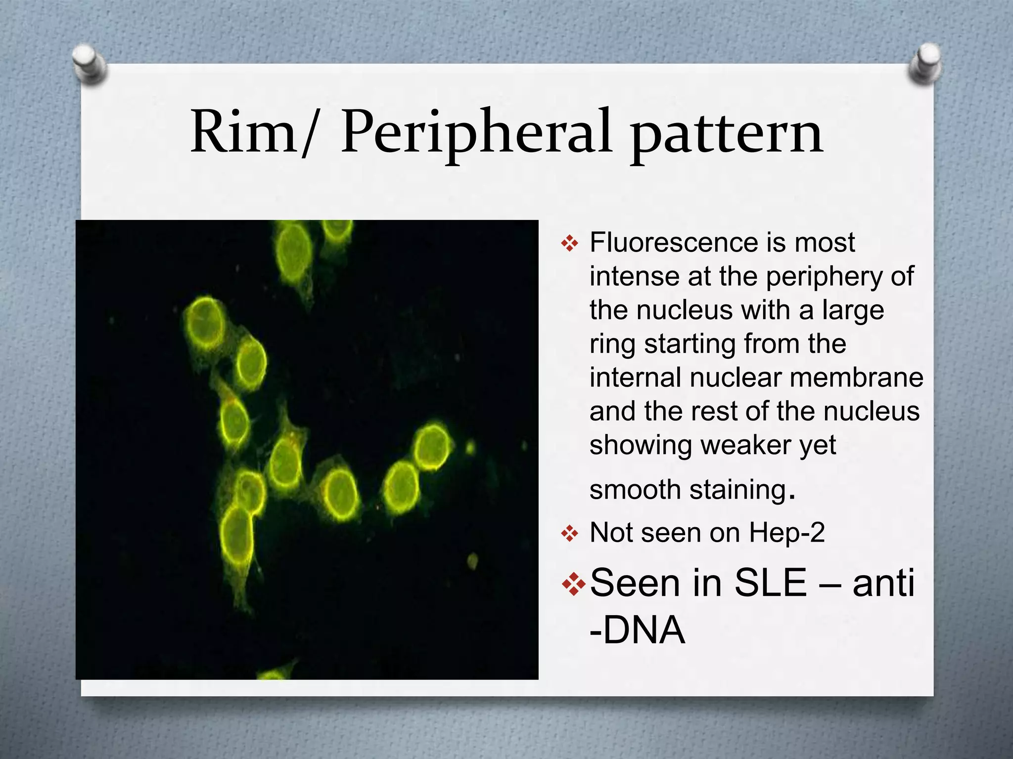 Rim/ Peripheral pattern
 Fluorescence is most
intense at the periphery of
the nucleus with a large
ring starting from the
internal nuclear membrane
and the rest of the nucleus
showing weaker yet
smooth staining.
 Not seen on Hep-2
Seen in SLE – anti
-DNA
 