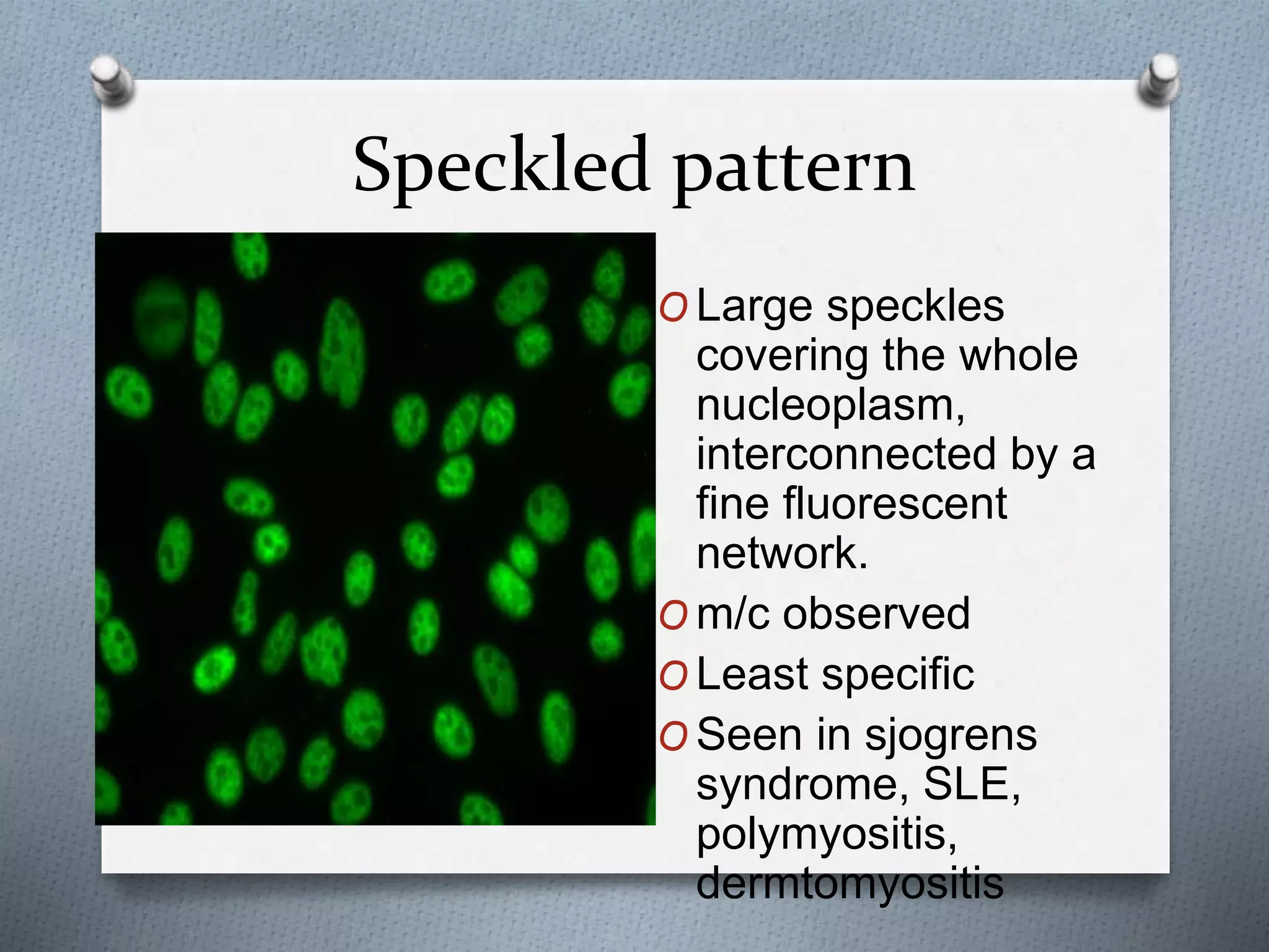 Speckled pattern
O Large speckles
covering the whole
nucleoplasm,
interconnected by a
fine fluorescent
network.
O m/c observed
O Least specific
O Seen in sjogrens
syndrome, SLE,
polymyositis,
dermtomyositis
 