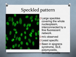 Speckled pattern
O Large speckles
covering the whole
nucleoplasm,
interconnected by a
fine fluorescent
network.
O m/c observed
O Least specific
O Seen in sjogrens
syndrome, SLE,
polymyositis,
dermtomyositis
 