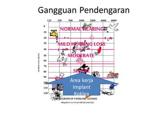 Gangguan Pendengaran
Area kerja
Implant
Koklea
 