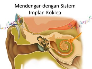 Mendengar dengan Sistem
Implan Koklea
 
