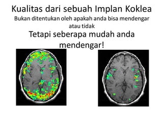 Kualitas dari sebuah Implan Koklea
Bukan ditentukan oleh apakah anda bisa mendengar
atau tidak
Tetapi seberapa mudah anda
mendengar!
 
