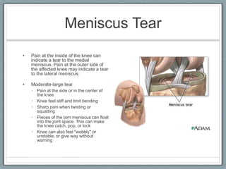 Interesting FactsAcute knee injuries in sports include: contusions, sprains, strains, fractures, and dislocations.90% of the time ACL tear is misdiagnosed.Severe ligament injuries: hallmark sign of which is instability.Unanticipated moves can result in dynamic (musclotendinous) or static (capsilar, meniscal, ligament).A snapping, popping, ripping, or tearing sensation at the time of injury is generally indicative of a severe injury.After an injury knowing that full extension of the knee was possible practically preludes the possibility of a dislocation, locked, buckle-handed meniscus tear.