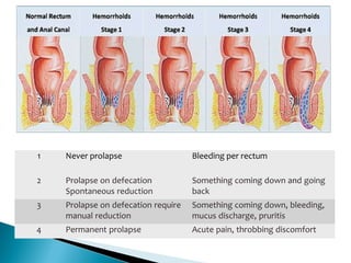 •
•
•
1 Never prolapse Bleeding per rectum
2 Prolapse on defecation
Spontaneous reduction
Something coming down and going
back
3 Prolapse on defecation require
manual reduction
Something coming down, bleeding,
mucus discharge, pruritis
4 Permanent prolapse Acute pain, throbbing discomfort
 