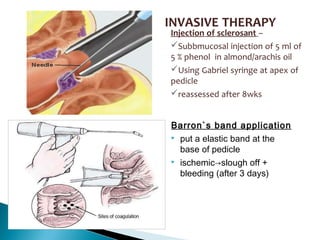INVASIVE THERAPY
Injection of sclerosant –
Subbmucosal injection of 5 ml of
5 % phenol in almond/arachis oil
Using Gabriel syringe at apex of
pedicle
reassessed after 8wks
Barron`s band application
 put a elastic band at the
base of pedicle
 ischemic→slough off +
bleeding (after 3 days)
 