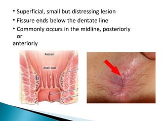 • Superficial, small but distressing lesion
• Fissure ends below the dentate line
• Commonly occurs in the midline, posteriorly
or
anteriorly
 