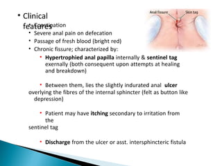 • Clinical
features• Constipation
• Severe anal pain on defecation
• Passage of fresh blood (bright red)
• Chronic fissure; characterized by:
• Hypertrophied anal papilla internally & sentinel tag
exernally (both consequent upon attempts at healing
and breakdown)
• Between them, lies the slightly indurated anal ulcer
overlying the fibres of the internal sphincter (felt as button like
depression)
• Patient may have itching secondary to irritation from
the
sentinel tag
• Discharge from the ulcer or asst. intersphincteric fistula
 