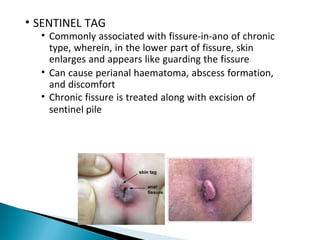 • SENTINEL TAG
• Commonly associated with fissure-in-ano of chronic
type, wherein, in the lower part of fissure, skin
enlarges and appears like guarding the fissure
• Can cause perianal haematoma, abscess formation,
and discomfort
• Chronic fissure is treated along with excision of
sentinel pile
 