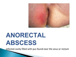 ANORECTAL
ABSCESS
infected cavity filled with pus found near the anus or rectum
 